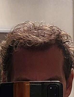 One year after using our product, hair restored